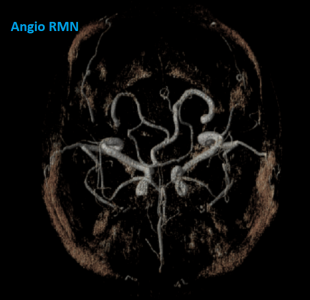 RM angio intracranica 2