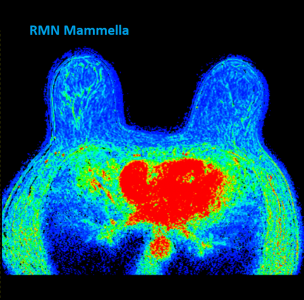 risonanza magnetica mammella